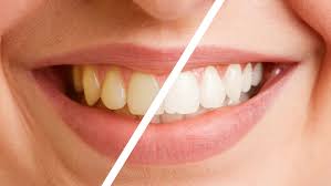 Clareamento Dental